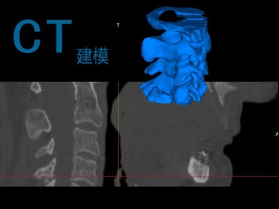 医院CT颈椎文件三维重建骨骼建模